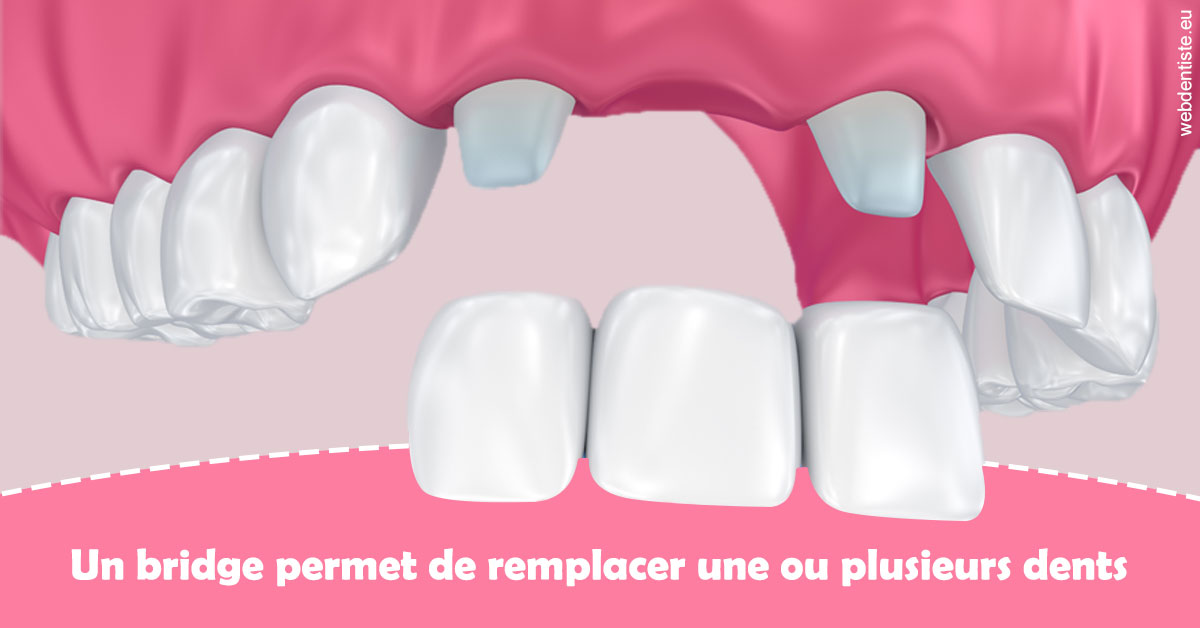 https://selarl-athias-lezmi.chirurgiens-dentistes.fr/Bridge remplacer dents 2