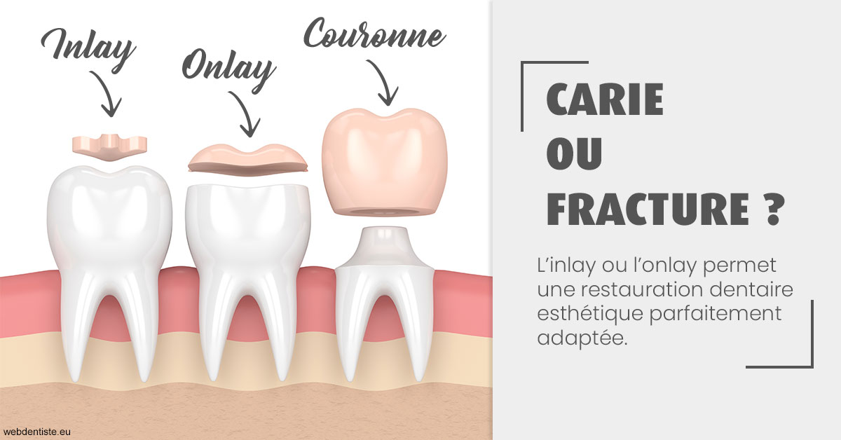 https://selarl-athias-lezmi.chirurgiens-dentistes.fr/T2 2023 - Carie ou fracture 1