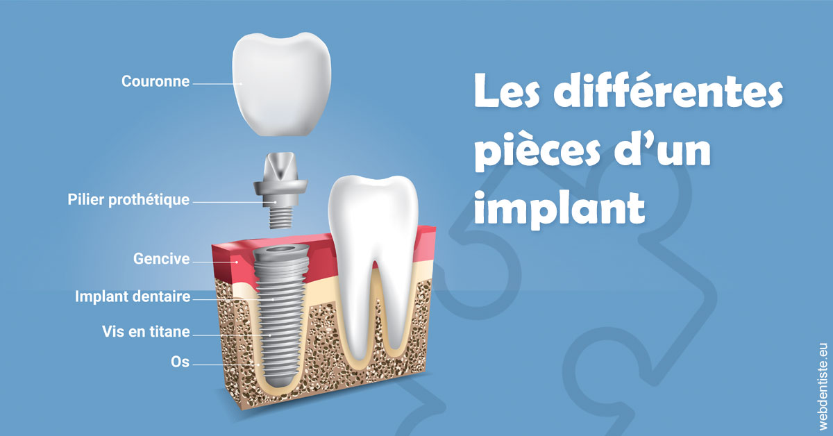 https://selarl-athias-lezmi.chirurgiens-dentistes.fr/Les différentes pièces d’un implant 1